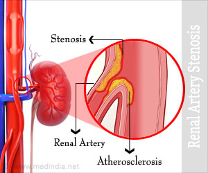 Renal Artery Stenosis (RAS) - Causes, Symptoms, Diagnosis, Treatment, Risk Factors