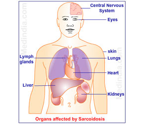 Sarcoidosis - Symptoms - Diagnosis - Treatment - Prognosis