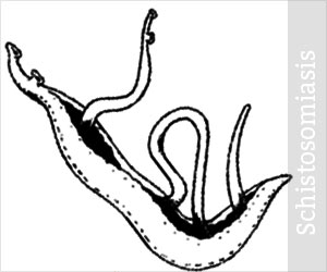 Schistosomiasis - Causes, Symptoms, Diagnosis, Treatment, Prevention