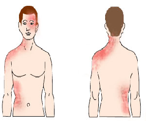 About Shingles