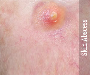 Boils | Skin Abscess - Causes, Symptoms, Diagnosis, Treatment