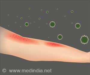 Rashes - Types, Causes, Symptoms, Diagnosis, Treatment