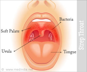 Strep Throat - Symptom Evaluation