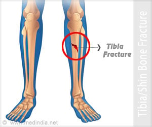 Tibia (Shinbone) Shaft Fractures - Causes, Symptoms, Diagnosis, Treatment