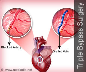 Coronary Artery Bypass Graft (CABG) - Triple Bypass Surgery