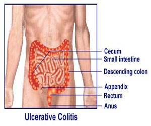 Ulcerative Colitis
