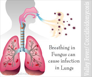 Valley Fever | Coccidioidomycosis - Causes, Symptoms, Diagnosis, Treatment, Prevention