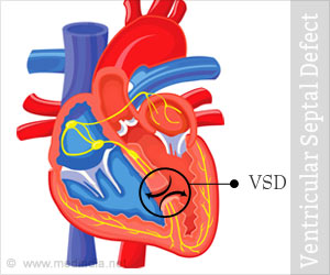 Ventricular Septal Defect (VSD) - Causes, Symptoms, Complications, Treatment, Prevention