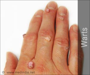 Warts - Causes Types Diagnosis Treatment Home Remedies
