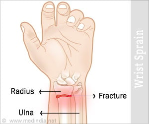 Wrist Sprain - Causes, Symptoms, Diagnosis, Treatment