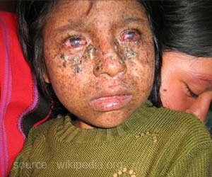 Xeroderma Pigmentosum - An Inherited Precancerous Condition
