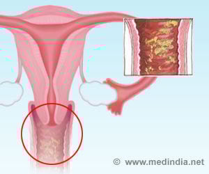 Yeast Infections - Symptoms, Causes, Prevention and Treatment