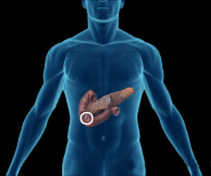 Zollinger–Ellison Syndrome - Causes - Symptoms - Diagnosis - Treatment