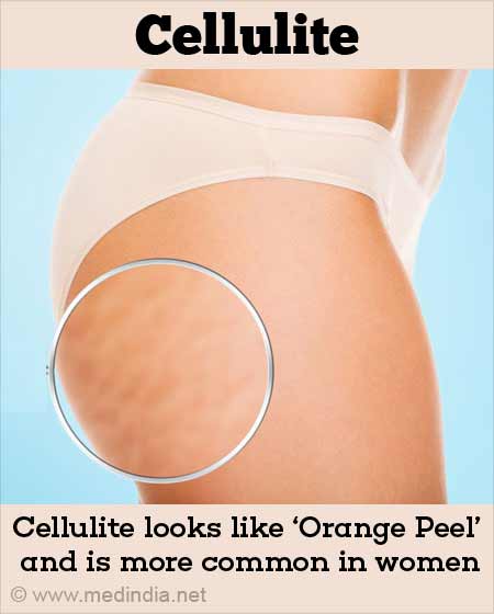 Cellulite Treatment - Causes, Risk Factors, Treatment, Alternative Medicines