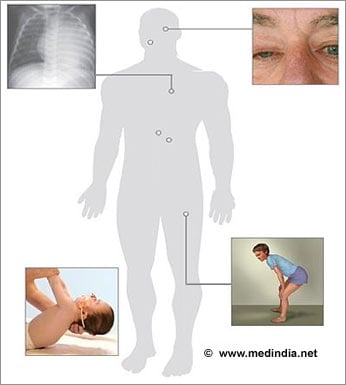 Pompe Disease Causes Types Symptoms Signs Diagnosis Treatment FAQs