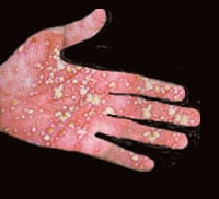 Psoriasis - Symptoms and Signs