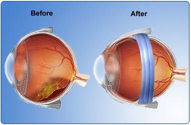 retinal detachment treatment