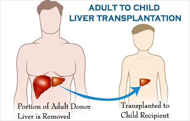 Liver Transplant in India