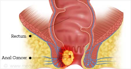 450px x 237px - Anal Cancer | Cancer of Anal - Causes, Symptoms, Staging, Treatment,  Prognosis & Prevention