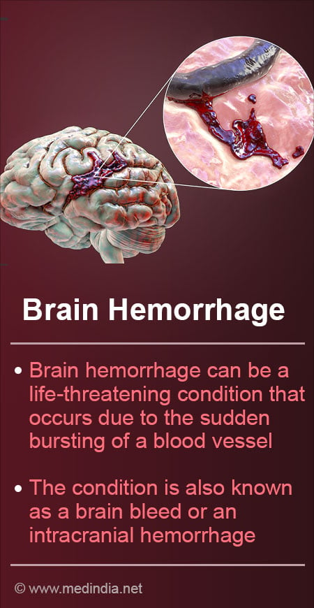 Brain Hemorrhage  Intracranial Hemorrhage - Causes, Symptoms, Diagnosis,  Treatment & Prevention