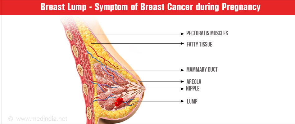 BREAST CANCER DURING PREGNANCY AND HOW DOES BREAST CANCER AFFECT
