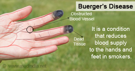 Buerger S Disease Shown Explained Using D Medical Off