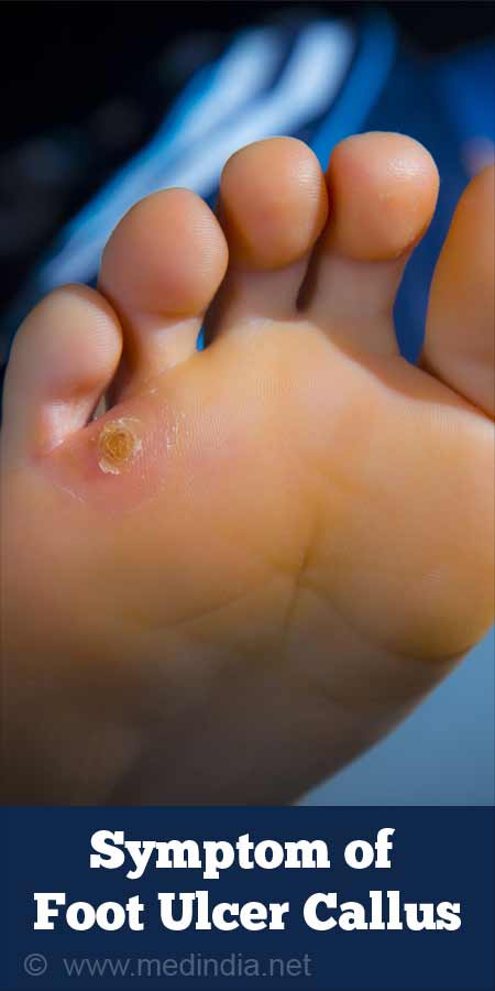 Diabetic Foot Ulcer Stages - Foot and Ankle Podiatrists