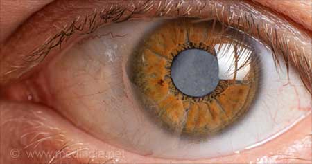 Cataract - Causes, Symptoms, Diagnosis, Treatment & Prevention