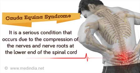 Cauda Equina Syndrome - Frequently Asked Questions