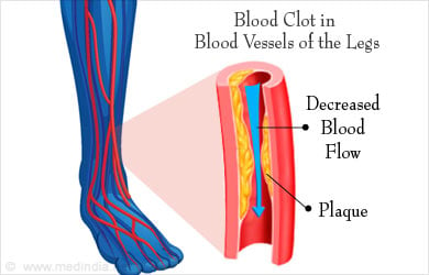 Compartment Syndrome - Types, Causes, Symptoms, Diagnosis, Treatment