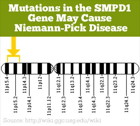 Niemann-Pick disease A or B in four pediatric patients and SMPD1