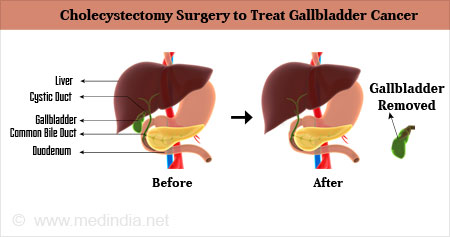 How To Prevent Gallbladder Cancer - Amountaffect17