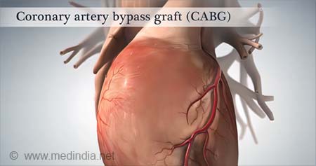 coronary artery bypass graft scar