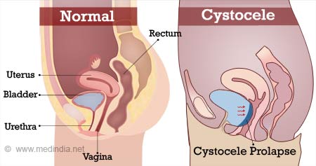 Urethral Prolapse: Causes, Symptoms, Diagnosis & Treatment