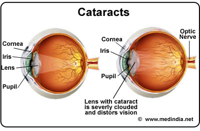 Causes of Double Vision