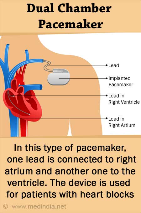 Cardiac Pacemaker for Abnormal Heart Rhythms – Types, Advantages, Risks