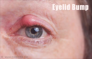Swollen Eyelids: What Is Causing My Swollen Eyelids?