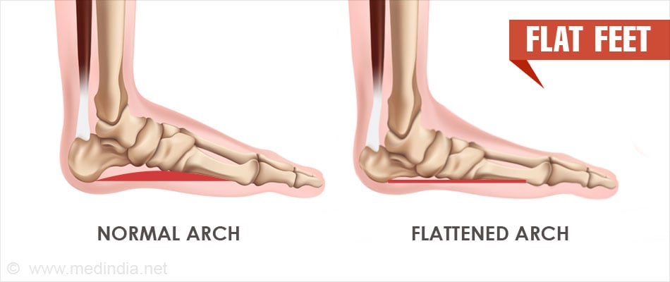 Flat Feet  Pes Planus - Causes, Symptoms, Diagnosis, Treatment
