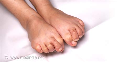 Foot Orgasm Syndrome Causes Diagnosis Treatment