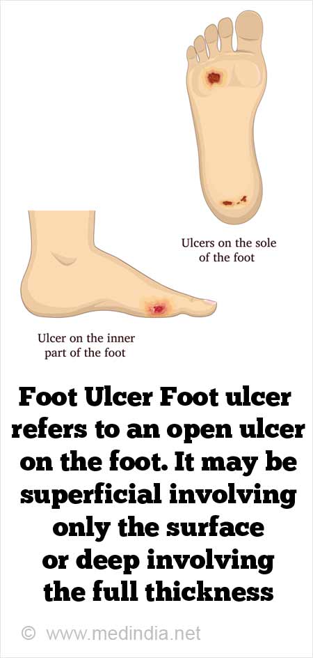 icd 10 code for diabetic foot ulcer with osteomyelitis