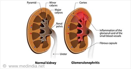 glomerulonephritis images
