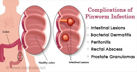 Pinworms kezelése: tünetek és gyógyszerek - Szövődmények March Pinworm kezelés gyermekek számára