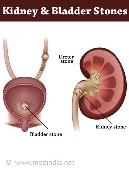 Renal Calculi Icd 10