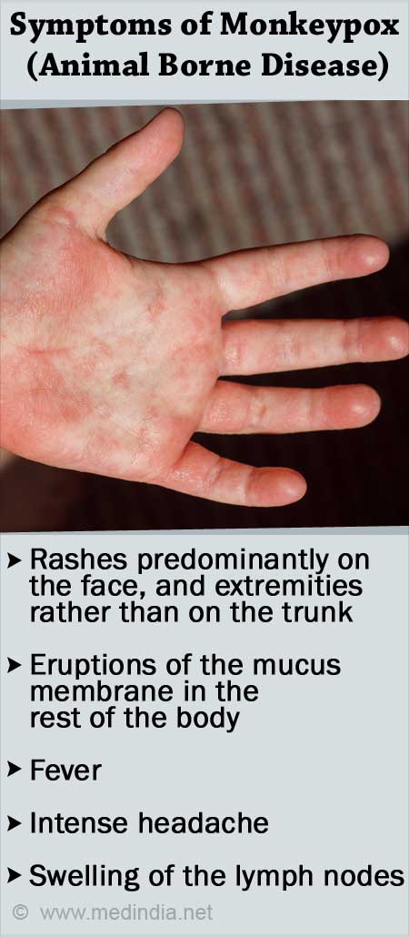 Mpox (Monkeypox): Signs, Symptoms, and Complications