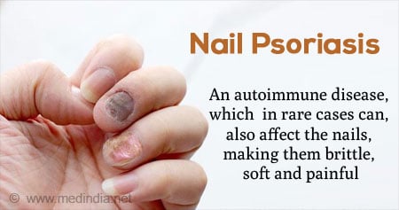 6 Tips on Managing Nail Psoriasis - Natural Skin Revival