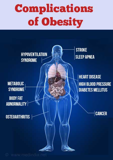 childhood obesity complications