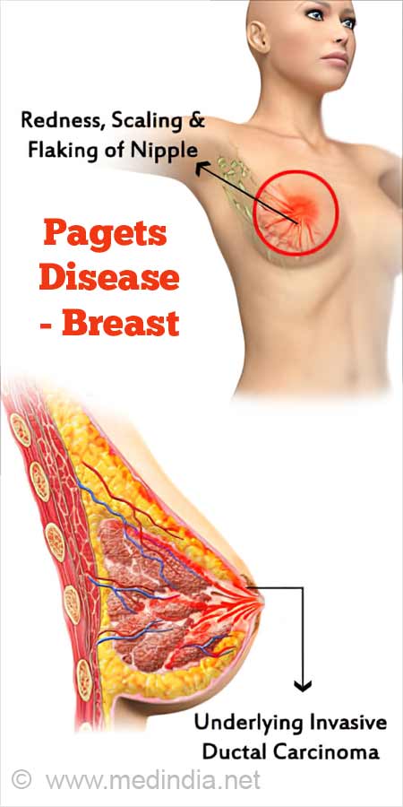 Paget's disease of the breast: Causes, symptoms, treatment, and more