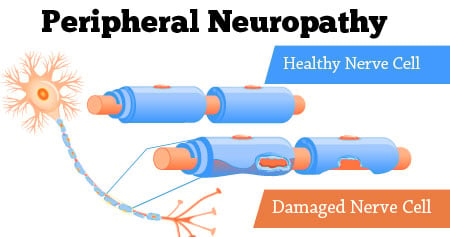 What Is Neuropathy? Symptoms, Causes, Diagnosis, Treatment And