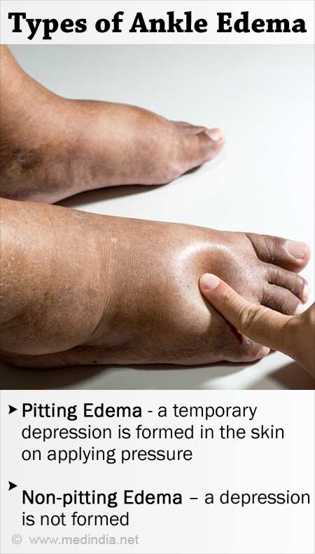 Pitting Edema VS Non-Pitting Edema: What's The Difference?, 60% OFF