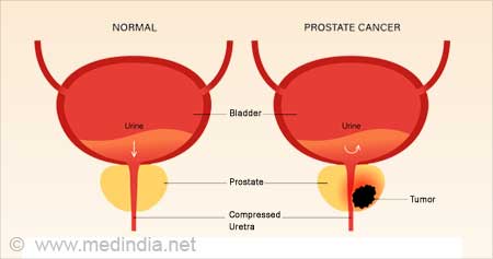 Prostate Cancer | Cancer of Prostate - Incidence, Prevention, Causes,  Symptoms & Treatment
